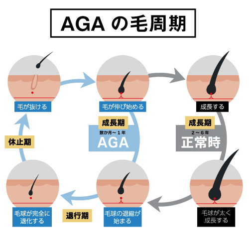 AGAの毛周期の画像