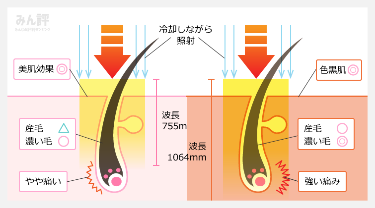 G－MAX（アレキサンドライト＆YAGレーザー）図解