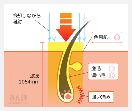 ジェントルYAG（YAGレーザー）図解