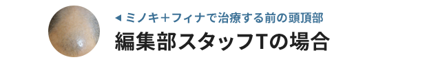 みん評編集部スタッフTのAGA治療経過報告